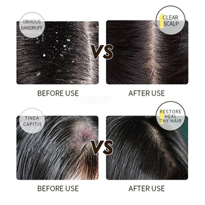 Champú Anticaspa, Tratamiento Capilar con Queratina, Alivio del Picor, Cuidado del Cuero Cabelludo, Producto para el Cuidado del Cabello para la Caspa Persistente, Vegano - Product Image 4