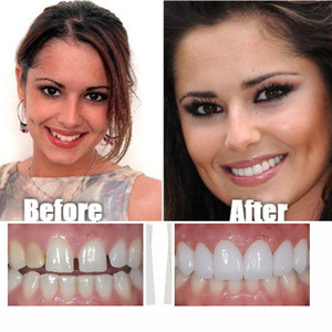 Kit de Reparación Dental Temporal de Dientes Postizos Superiores e Inferiores, Carillas, Dentaduras Postizas, Aparatos Ortodóncicos, Instrumentos y Equipos - Product Image 5