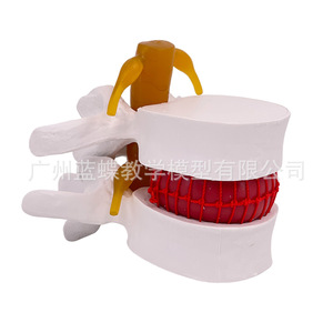 Simulation pédagogique du modèle de hernie discale lombaire humaine, démonstration de mesure de la pression vertébrale, vertébral - Product Image 4