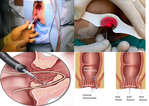 Máquina LÁSER MÉDICA PARA hemorroides 980 1470nm Láser de diodo Alemania Urología Láser Dispositivo de Cirugía de fístula EVLT/ENT Proctología rectal - Product Image 3
