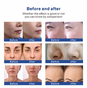 Appareil professionnel d'hydrodermabrasion <span class=keywords><strong>Hydra</strong></span> Vacuum avec analyseur de peau pour un nettoyage en profondeur, une exfoliation et un resserrement des pores - Product Image 6