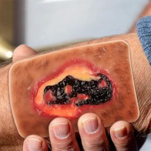 Model Luka Jaringan Necrotic KyrenMed 3 Jenis Model Luka Necrosis Basah dan Kering untuk Pendidikan Perawatan Luka - Product Image 6