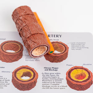 Modelo de formación de aterosclerosis y trombosis de arteria, modelo de Anatomía Humana, modelo de proceso de esclerosis vascular de cuatro etapas - Product Image 4