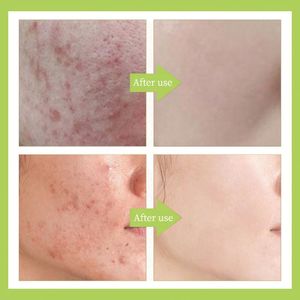 OEM Wholesale Skin Care Anti Acne Serum Effective Mild Fruit Acid Acne Treatment <b>Face</b> Serum 30ML Serum for Acne Skin - Product Image 4