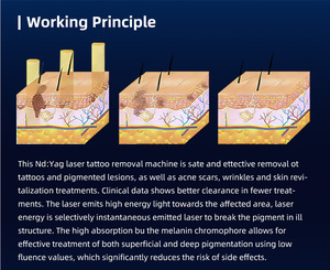 Laser Picosecondo Q-Switched NdYAG 755nm con Raffreddamento ad Acqua per Rimozione Macchie Scure, Anti-Lentiggini e Schiarimento della Pigmentazione - Product Image 4