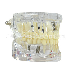 Modelos dentales, modelos de patología dental transparentes naturales, modelos de patología dental y modelos médico-paciente. - Product Image 3