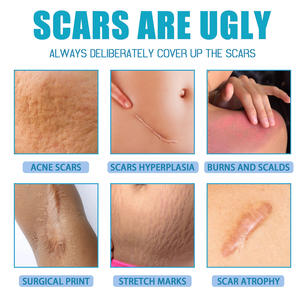 OEM/ODM Gel silikon perawatan bekas luka pelembap perbaikan bekas luka salep bakar untuk perawatan bekas luka - Product Image 3