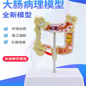 Modelos patológicos de intestino grueso, modelo de colon pequeño, modelo de lesiones del intestino grueso, enfermedades intestinales, modelo de lesiones del colon - Product Image 2