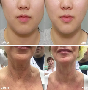 Potente máquina multipolar HIFU RF de 1280W 22D con pantalla de 13.3 pulgadas para tratamiento de estiramiento facial, cuello y reducción de grasa abdominal. - Product Image 6