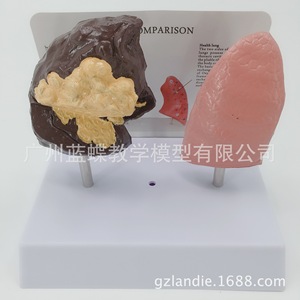 Modelo de pulmón, molde de la estructura pulmonar, riesgos para la salud por el tabaquismo, sistema respiratorio pulmonar del fumador, modelo anatómico patológico del pulmón - Product Image 1