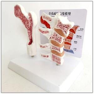 แบบจำลองพยาธิวิทยาโรคกระดูกพรุน แบบจำลองกระดูกต้นขาและกระดูกสันหลังส่วนเอว แบบจำลองพยาธิวิทยาโรคกระดูกเสื่อม 4 ขั้นตอน - Product Image 3