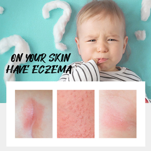 Crème Apaisante pour l'Eczéma, Soin Réparateur <span class=keywords><strong>Efficace</strong></span> Après une Seule Utilisation, Marque Privée OEM - Product Image 2