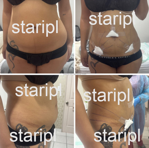 Fibra plana radial óptica Médica Quirúrgica reutilizada esterilizada para cirugía liposucción venas varicosas <span class=keywords><strong>piernas</strong></span> cirugía invasiva láser - Product Image 5