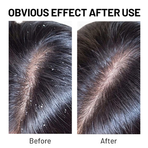Aceite de Coco OEM <span class=keywords><strong>para</strong></span> <span class=keywords><strong>el</strong></span> Tratamiento del <span class=keywords><strong>Cabello</strong></span> y Cuero Cabelludo - Anticaspa, Reparación del <span class=keywords><strong>Cabello</strong></span> Dañado y Nutritivo - Product Image 6