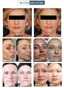 Machine de masque facial de dôme d'oxygène de thérapie de pistolet de jet d'oxygène hyperbare professionnel à vendre - Product Image 5