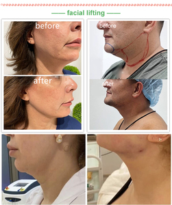 Endolaser <span class=keywords><strong>lipolaser</strong></span> papada mặt nâng endoskin 980nm 1470nm hút mỡ máy - Product Image 6