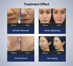 Rouleau de massage facial en gros / Appareil de réduction de la cellulite / Machines de massage thérapeutique amincissantes / Appareil de remodelage corporel - Product Image 6