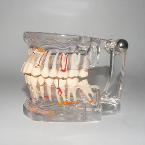 Modelo Dental Transparente <span class=keywords><strong>de</strong></span> Tamaño Real con Dientes Patológicos para Demostración en la Enseñanza Dental - Product Image 4