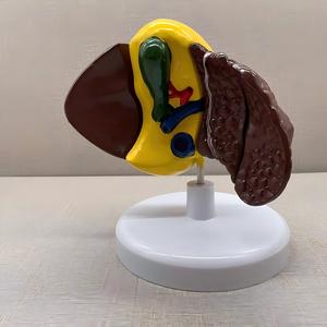 แบบจำลองการสอนเกี่ยวกับมะเร็งตับพร้อมฐาน - เครื่องมือกายวิภาคที่ถอดออกได้สำหรับการศึกษาโรคตับ - Product Image 4