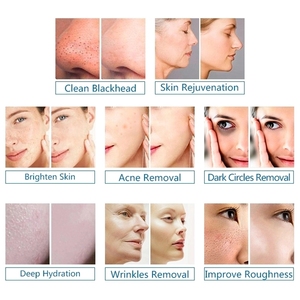 Nouveautés : Appareil de beauté portable 6 en 1 pour éliminer les cicatrices d'acné, lifter la peau du visage, éliminer les rides - Product Image 6