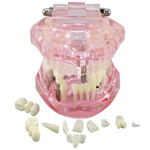 1 modèle dentaire d'étude et de démonstration d'implant dentaire avec restauration, rose - Product Image 2
