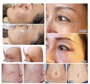 Microneedling avec <span class=keywords><strong>radiofréquence</strong></span>, appareil de microneedling RF, machine de microneedling fractionnel RF, machine <span class=keywords><strong>à</strong></span> <span class=keywords><strong>micro</strong></span>-<span class=keywords><strong>aiguilles</strong></span> fractionnelles - Product Image 6