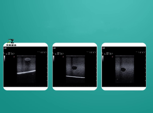 Modelo de punción guiada por ultrasonido para entrenamiento interventional de ecografía mamaria con tumor, color piel - Product Image 5