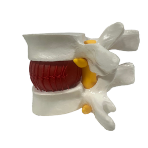 Model kerangka sains medis, untuk demonstrasi herniasi Lumbar bahan PVC untuk pelatihan perawat di sekolah - Product Image 2