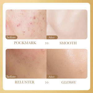 OEM ODM özel etiket SADOER Lysosomal Nicotinamide <span class=keywords><strong>C</strong></span> vitamini beyazlatma onarım akne dondurularak kurutulmuş toz seti cilt bakımı - Product Image 6