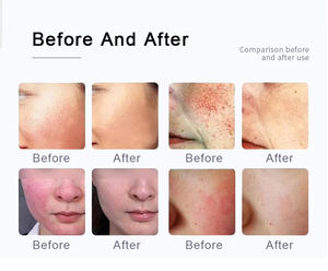 2026 Grande Promotion Exclusivité Salon Équipement Professionnel Laser 980nm pour l'Élimination Vasculaire et des Veines Rouges - Product Image 6