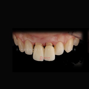 Fournitures pour prothèses dentaires Produits dentaires Placage en porcelaine Restauration de prothèses fixes <span class=keywords><strong>Sourire</strong></span> <span class=keywords><strong>parfait</strong></span> - Product Image 2