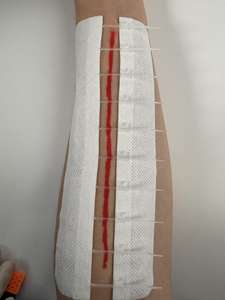 MDT <span class=keywords><strong>เทป</strong></span><span class=keywords><strong>ปิด</strong></span><span class=keywords><strong>แผล</strong></span>แถบซิปใช้ทางการแพทย์ได้รับการรับรอง CE Class II 6.5x10.3cm - Product Image 6