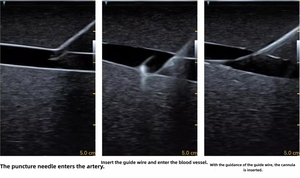 Simulador de Entrenamiento ECMO - Modelo de Entrenamiento para Punción Arterio-Venosa Femoral Guiada por Ultrasonido - Product Image 6
