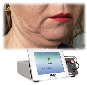 <span class=keywords><strong>Liposucción</strong></span> de relleno a tope 980nm Endolaser Lipólisis Máquina de estiramiento facial Fibra óptica 400um 600um Anti celulitis 1470nm láser - Product Image 4