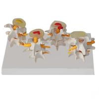 Modelo de Comparación de Degeneración de Vértebras Lumbares en 4 Etapas, Modelo de Anatomía de Columna Vertebral con Gráfico Anatómico