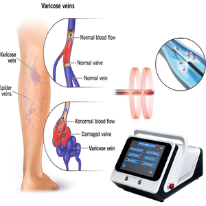 Vasos Tratamiento Ablación Venas varicosas Doble onda 1470nm <span class=keywords><strong>Telangiectasias</strong></span> Lesiones vasculares de la piel EVLT 980nm Terapia de absorción - Product Image 1