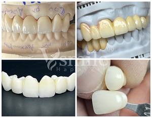 Blocs de Zircone Dentaire Vsmile Zirconium 98mm pour Couronne Céramique Dentaire CAD/CAM 700Mpa-1200Mpa - Product Image 5