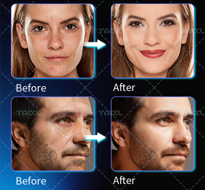 Dispositivo de Belleza Todo en Uno que Estimula <span class=keywords><strong>la</strong></span> Regeneración Continua de Colágeno <span class=keywords><strong>para</strong></span> Reducir las Líneas Finas - Product Image 4