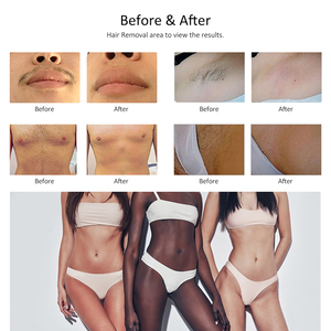 Épilation de beauté haute puissance meilleure machine d'épilation au <span class=keywords><strong>laser</strong></span> à 4 longueurs d'onde - Product Image 6