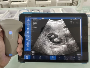 Échographe Doppler Couleur Portable Sans Fil à Sonde Convexe Personnalisable pour la Grossesse - Product Image 6