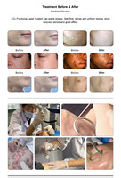 Équipement de beauté de machine de visage de CO2 fractionnaire de laser médical pour le traitement de laser
