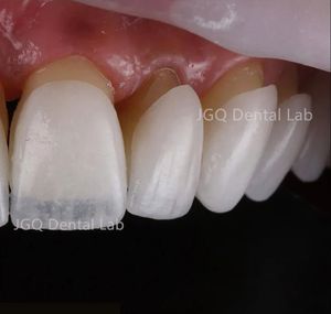 Lapisan porselen yang sangat indah dibuat dengan pengecoran dengan kekuatan tinggi dan terlihat alami dari China <span class=keywords><strong>Dental</strong></span> Lab - Product Image 3