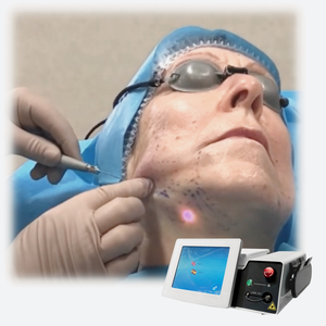 Máquina de Endoláser F-D-A para Rejuvenecimiento Facial, Láser de 650nm, 980nm y 1470nm, Máquina de Lipólisis Láser, Liposucción y Endolifting - Product Image 5
