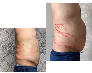 Producto Mejor Clasificado Máquina de Lipo Inteligente Máquina de Liposucción Inyección de Lipólisis para Cirugía de Adelgazamiento - Product Image 2