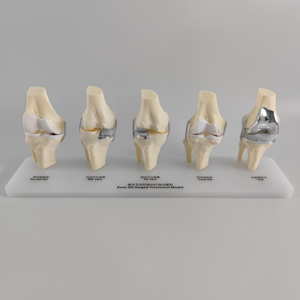 Modèle de comparaison d'implants totaux unicompartimentaux pour l'<span class=keywords><strong>arthrose</strong></span> du genou à 5 stades, modèle de traitement progressif - Product Image 2