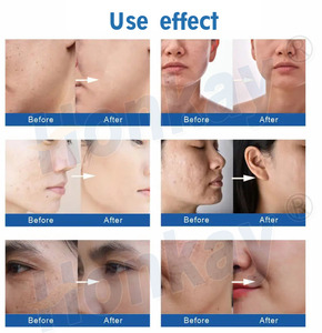 Appareil personnalisable pour éclaircir la peau et éliminer les points noirs avec support de formation gratuit, machine de beauté à jet d'eau et d'oxygène - Product Image 6
