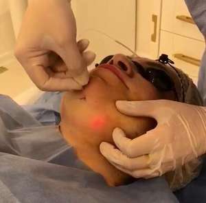 Peralatan Bedah Fiberlifting Lipolisis <span class=keywords><strong>Laser</strong></span> Diode 980nm+1470nm <span class=keywords><strong>Liposuction</strong></span> Endolaser Pengencang Kulit Kanula Fiber - Product Image 6