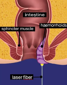 Clínica Anal Fístula Láser Diodo Láser 980 1470nm Hemorroide Tratamiento <span class=keywords><strong>Hemorroides</strong></span> Eliminación Vascular Máquina médica Dispositivo EVLT - Product Image 5