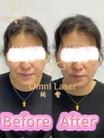 2025 EMS RF dispositif de contour du visage utilisation de Salon professionnel stimulé muscle EMS Smart RF Machine