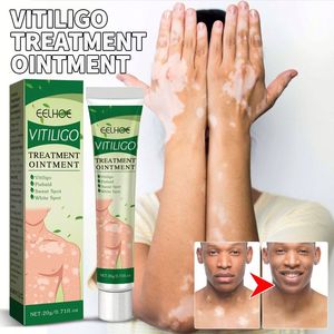 EELHOE Vitiligo Traitement Crème Ointment pour l'élimination des <span class=keywords><strong>taches</strong></span> <span class=keywords><strong>blanches</strong></span>, de la teigne, de la leucoplasie cutanée et de la dermatite 20ml EELHOE Vitiligo - Product Image 5